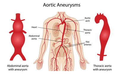 Anévrismes de l’aorte thoracique (AAT)