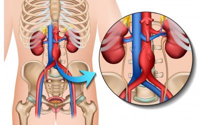Anévrismes de l’aorte abdominale